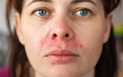 Junge Frau mit Akne und Hautproblemen im Gesicht.