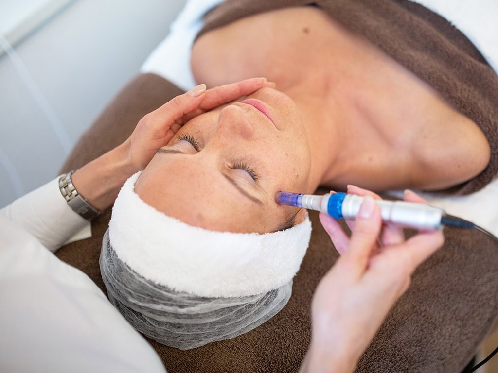Frau erhält Microneedling-Gesichtsbehandlung im Kosmetikstudio
